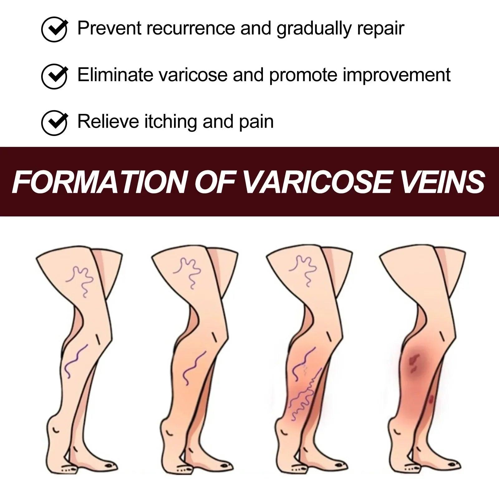 Varicose Vein Leg Skin Care Cream - Dabfavshop