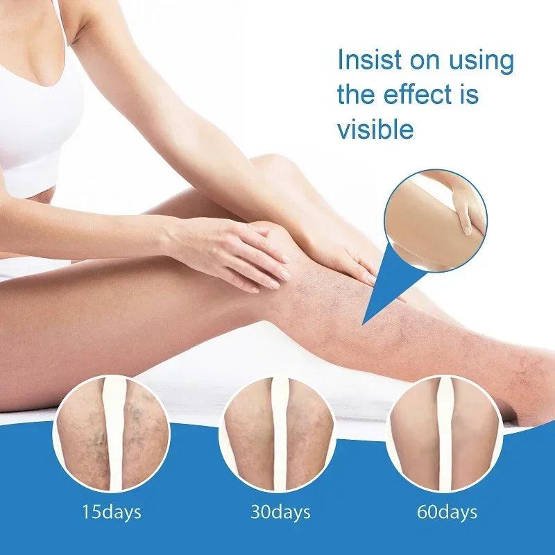 Varicose Vein Leg Skin Care Cream - Dabfavshop